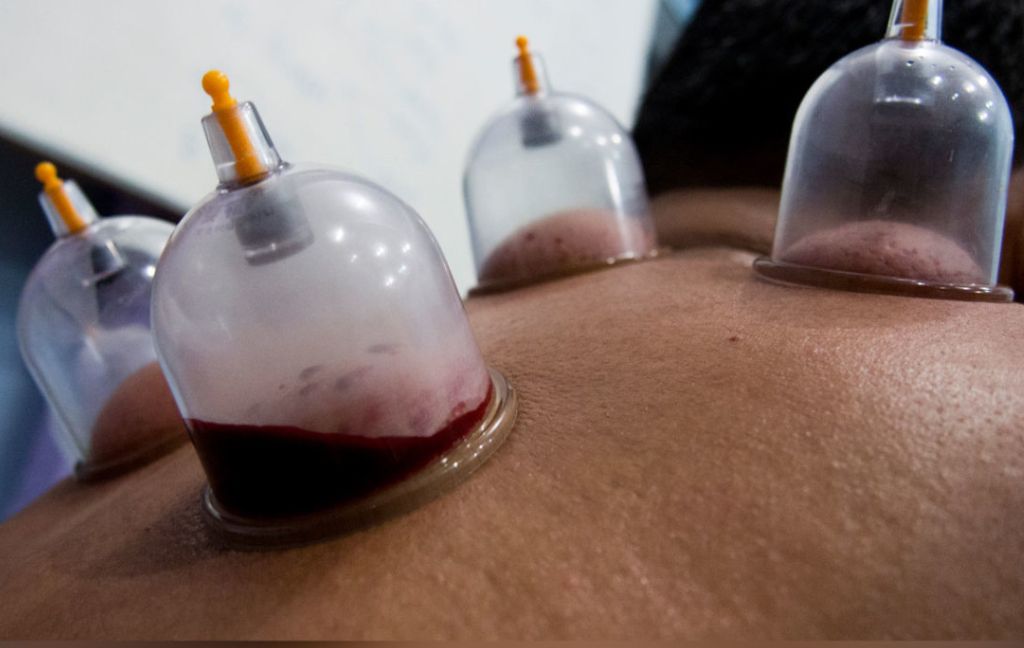 Acupuncture for arthritis